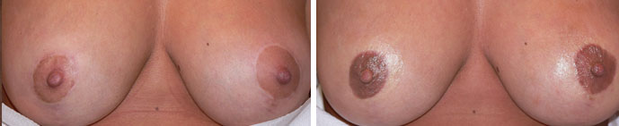 Areola Repigmentation with Scar Camouflaging Before and Immediately After