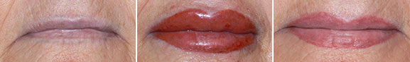 Full Lips Before, Immediately After, and Healed