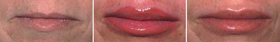 Full Lips Before, Immediately After, and Healed